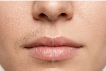 How to Get Rid of Facial Hair at Home — Naturally and Permanently