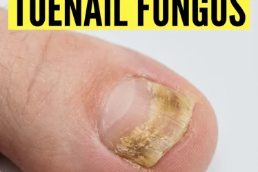 How to Get Rid of Toenail Fungus Using Home Remedies