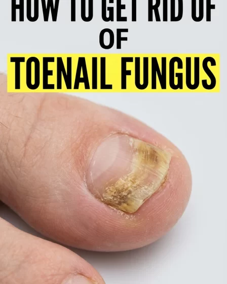 How to Get Rid of Toenail Fungus Using Home Remedies