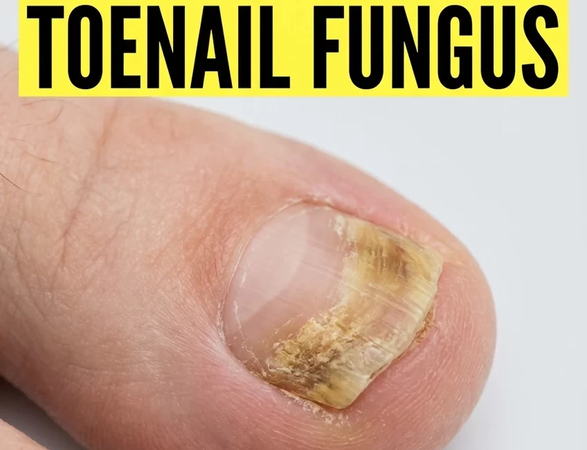 How to Get Rid of Toenail Fungus Using Home Remedies