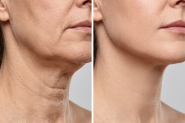 How to Tighten Neck Skin Naturally Exercises, Oils and Home Remedies That Work