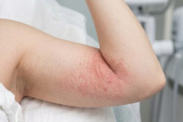 Why Your Skinfold Rash Keeps Coming Back — And How to Finally Stop It