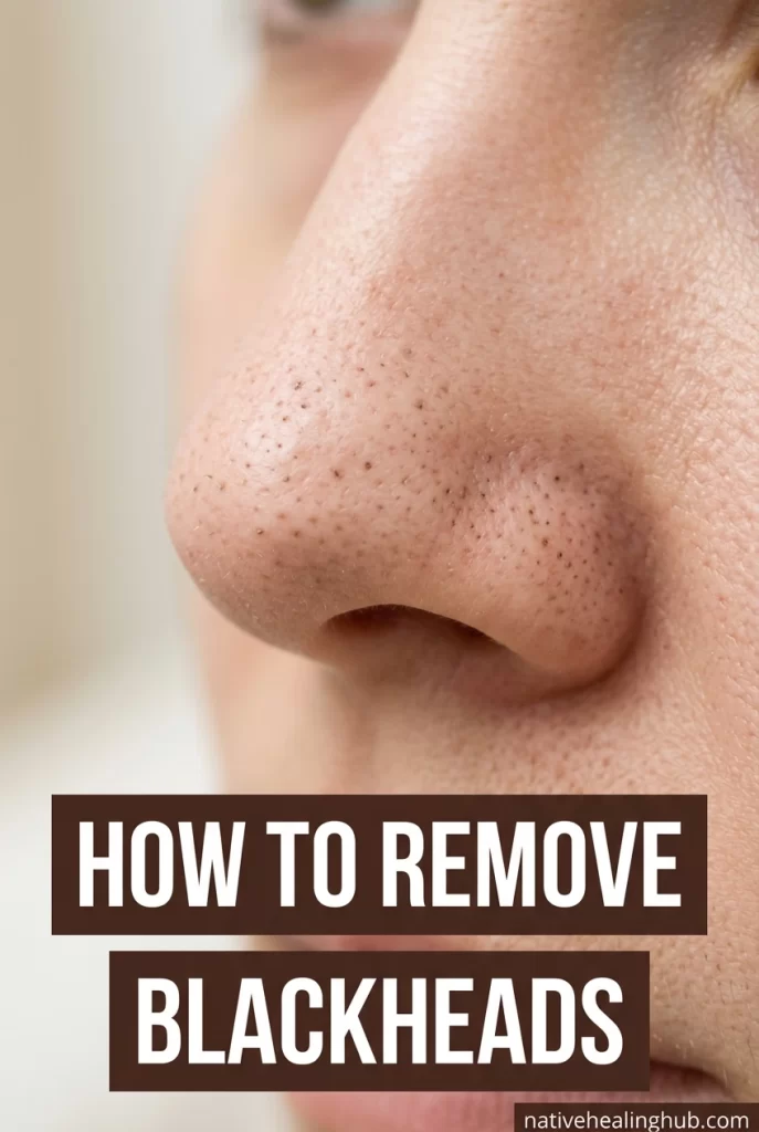 How to Remove Blackheads Naturally — 7 Home Remedies That Actually Clear Pores