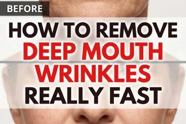How to Remove Deep Mouth Wrinkles Really Fast — Natural Remedies That Work